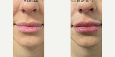 Woman treated with Juvederm - This is immediately after 1 syringe of Juvederm Volbella.