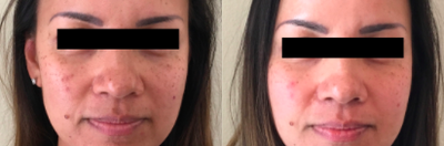 45-54 year old woman treated with Jessner Peel - The after picture is taken after 3 Jessner peels, spaced 3 weeks apart.