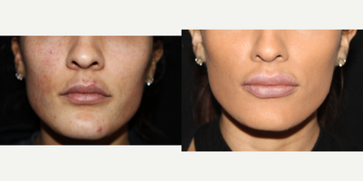 18-24 year old woman treated with Lip Implants - Permalip are revolutionary lip implants that are designed to look and feel natural, yet enhance your lip volume to your desired size. It does not deflate, degrade or rupture over time. Although its permanent, it is designed for the ease of placement if a patient wishes to achieve a larger or smaller enhancement or even return to the lips original appearance. It does not limit lip movement and provides a natural look.