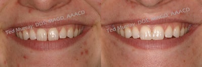 Cosmetic Bonding to close space - 
	Some people like the spaces between their teeth. Others would rather they didn&#39;t have them and want a non-invasive way to fix it. For this young lady we did Direct Composite Resin Bonding, careful to be sure of a good match and that the teeth were the same size and the composite emerged from the gingiva in a natural and harmonious emergence profile.
