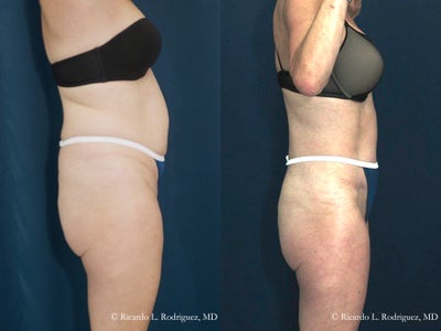 Mini Tummy Tuck - 	There are several liposuction techniques. Techniques are based on the amount of anesthetic injected to the tissues (wet, superwet, tumescent), the method used to suction the fat (manual suction via syringe, power assisted, ultrasonic, laser), and the size of the cannulas used (thin, regular). Used the tumescent technique with thin cannulas throughout the procedure to enhance smooth tissue contours. He believes that the thin 3 mm cannulas are essential for a uniform result. Some surgeons use larger 5 mm cannulas and can extract the fat faster.