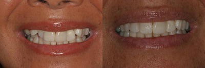 Invisalign  - Invisalign treatment in 10 months.