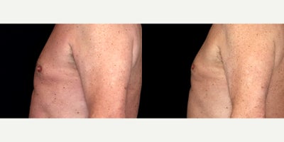 70 year old man treated with Nipple reduction - 70 year old man treated with Nipple reduction Photos depict before and 6 months after surgery