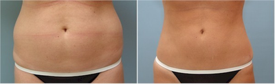 SmartLiposuction - 35 years old- This client underwent Smartliposuction to her abdomen.