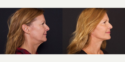 50-59 year old woman treated with Facelift - 50-59 year old woman treated with Facelift