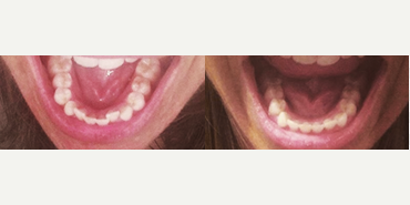 Straighten your teeth without braces - Photo provided courtesy of SmileDirectClub.