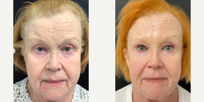 Woman treated with CO2 Laser, Laser Resurfacing, Daxxify - With minimal maintenance of CO2 laser resurfacing and Daxxify neuromodulator injections in the glabella and crows feet twice a year, this patient is looking younger and younger every time she walks into my office!Surgical intervention is not for everyone, however, there is always non-invasive treatments available to maintain and maximize desired results! This patient is very happy with her continuous progression and consistent improvement in her overall appearance.