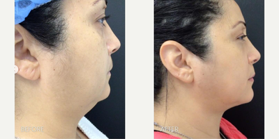 Woman treated with Secret RF - Without cutting or scars, I can redefine my patient's jawline and neck contour. After manual liposuction, I utilize Cuteras Secret PRO Radiofrequency Microneedling for incredible results and intervention for select patients.