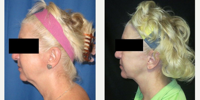 55-64 year old woman treated with Facelift - Woman treated with Face and Neck Lift with Fat Grafting. Patient had a full face and neck lift with facial fat grafting.