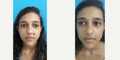 17 or under year old woman treated with Lipoma Removal - Removal