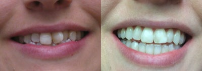Invisalign - This patient had severely misaligned teeth with brown spots.  After 15 months of Invisalign and whitening.  Dr. Thompson provides Invisalign and alternatives to Invisalign.