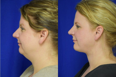 45-54 year old woman treated with Rhinoplasty - Primary Rhinoplasty with chin implant and liposuction in New Orleans woman by Dr. Sean Weiss in Metairie, Louisiana