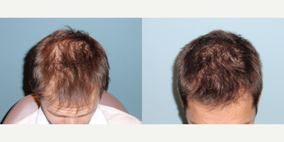 Luce LDS 100 Infrared Light Therapy - Male Patient suffering from Male Pattern Baldness (Alopecia)