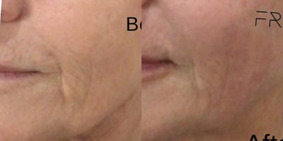 Woman treated with Skinvive by Juvederm - Woman treated with Skinvive by Juvederm