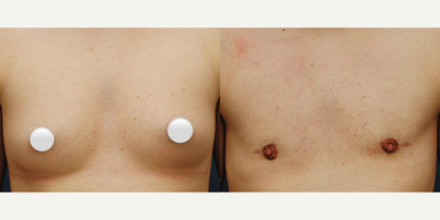 18-24 year old transgender woman treated with Masculinizing Top Surgery - Our 21 year old FTM patient at 6 months post Keyhole Top Surgery.