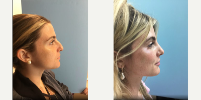 25-34 year old woman treated with Rhinoplasty - 25-34 year old woman treated with Rhinoplasty
