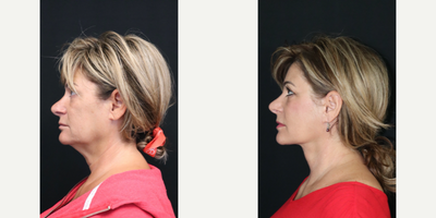 Facelift and Neck Lift - Facelift and Neck Lift - 6 months postop