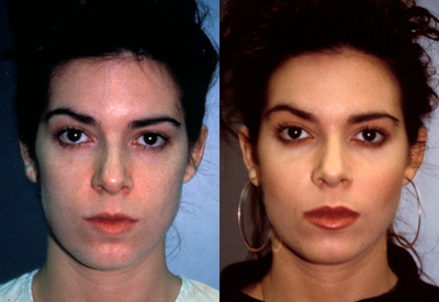 Cheek Implant  - Cheek Implant Before and After