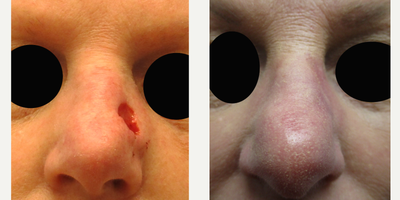 35-44 year old woman treated with Mohs Surgery, Facial Reconstructive Surgery - 36-year-old female before and 4 weeks after dermatologist Mohs removal of left nasal BCC (basal cell carcinoma) and reconstruction with a Full Thickness Skin Graft. Notice the smooth contour and natural look. Patient started using Dr. Sperons Natural Skin Care Natural Scar Support Treatment 2 weeks after reconstruction.