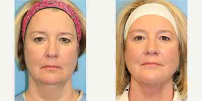 Woman treated with Lower Facelift - Woman treated with Lower Facelift as well as Neck Lift