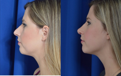 25-34 year old woman treated with Rhinoplasty in New Orleans - Rhinoplasty performed in New Orleans, Louisiana to reshape the nasal bridge and adjust the tip of the nose.