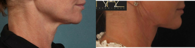 45-54 year old woman treated with Nonsurgical Neck Lift - Neck lift-MyEllevate.
