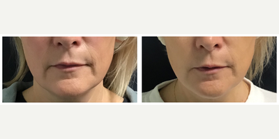 45-54 year old woman treated with Pelleve - Pelleve full face