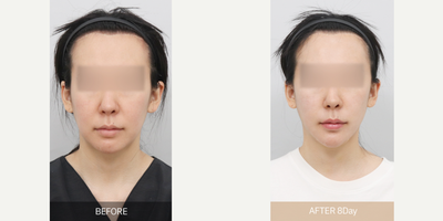 25-34 year old woman treated with Thread Lift - 