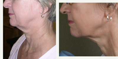 EndyMed 3DEEP - Photo provided courtesy of EndyMed Medical Ltd.