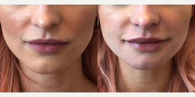 18-24 year old woman treated with Restylane Lyft - 0.8cc of Restylane Lyft in the superior and inferior lip, as well as the philtrum