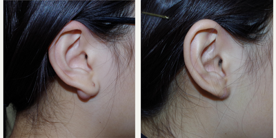 17 or under year old female treated with Ear Lobe Surgery - 14 year old female received an ear lobe repair and lesion removal; photos depict the patient's results 7 weeks post-op.