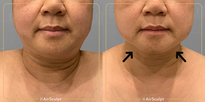 45-54 year old woman treated with AirSculpt - Chin AirSculpt+, our newly introduced fat removal and skin tightening treatment, helped this patient remove her double chin and improve skin laxity without having to endure invasive lift or lipo surgery.