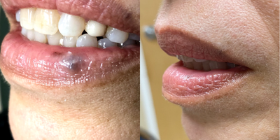 55-64 year old woman treated with Excel V - Before and after one treatment with Excel V on a venous lake on the lip