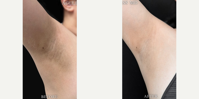 25-34 year old woman treated with Skin Lightening - 25-34 year old woman treated with Skin Lightening