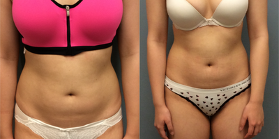 21 year old women treated with UltraShape body contouring treatment - This 21 year old woman was treated with the non-invasive body contouring/fat elimination treatment, UltraShape. Her treatment was comfortable and required no downtime.