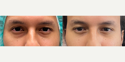 25-34 year old man treated with Eyelid Surgery, Skin Rejuvenation, Nonsurgical Facelift - 3 weeks after transconjunctival lower eyelid blepharoplasty