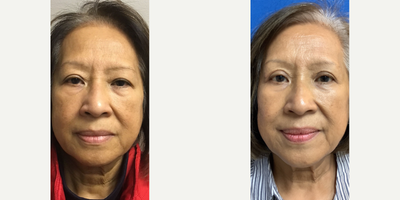 65-74 year old woman treated with Double Eyelid Surgery, MiXto Laser, Agnes RF - 65-74 year old woman treated with Double Eyelid Surgery, MiXto Laser, Agnes RF.