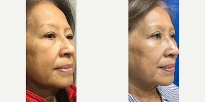 65-74 year old woman treated with Double Eyelid Surgery, MiXto Laser, Agnes RF - 65-74 year old woman treated with Double Eyelid Surgery, MiXto Laser, Agnes RF.