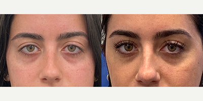 25-34 year old woman treated with Xeomin - This patient had Xeomin to correct upper eyelid ptosis (drooping)