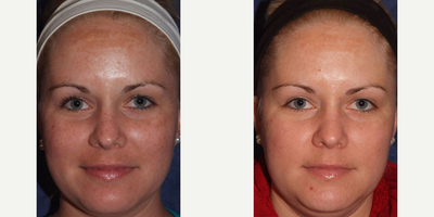 Spectra Laser for Sun Spots Patient 1 - Spectra Laser procedure for sun spots.