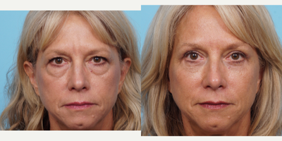 55-64 year old woman treated with Eyelid Surgery - This patient had a trichophytic browlift and upper and lower eyelid surgery. By just treating around the eyes can give a wonderful effect of youthfulness of brightness of the face.