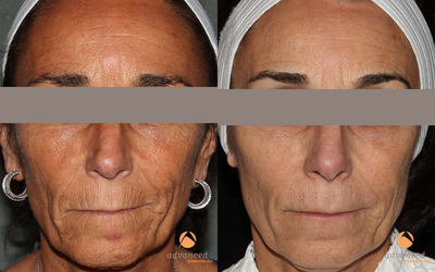 Female Treated with Sublime and Sublative eMatrix (etwo) Treatments - 
	The eTwoTM treatment combines Sublative Rejuvenation (eMatrix Resurfacing) and Sublime Skin Contouring (formerly known as ReFirme) treatments. Treatment with eTwoTM revives your skin to appear more youthful.
