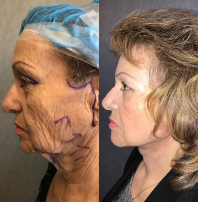 Face and Neck Lift - Full face and neck lift and upper eyelid surgery