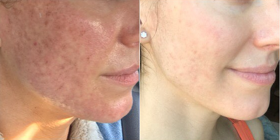 Woman treated with Fractional Laser - Woman treated with CO2 Laser Resurfacing, shown 3 weeks post op.