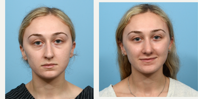 18-24 year old woman treated with Septoplasty - On this 24-year-old patient, Dr. Wise performed a rhinoplasty to correct a large dorsal hump, and septoplasty to improve breathing. 7 weeks post-op, she loves the appearance of her new nose!