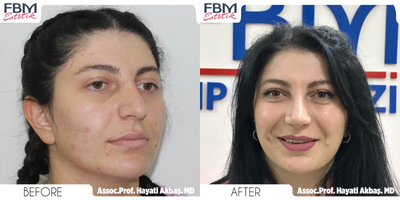 18-24 year old woman treated with Rhinoplasty - 18-24 year old woman treated with Rhinoplasty