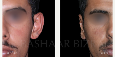 25-34 year old man treated with Ear Surgery, Earfold - 25-34 year old man undergoes Otoplasty with Dr Bashar Bizrah