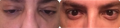 35-44 year old man treated with Belotero - This patient received an under eye Belotero treatment to improve his tired looking eyes. Here he is after his Belotero looking great and rested!!