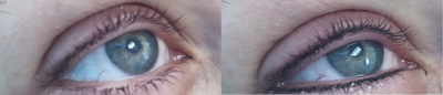 45-54 year old woman treated with Permanent Makeup - This treatment involves tattooing a light black line of ink across the lash-line, think of it as a light permanent eyeliner with a more natural finish. Results can last 3 to 5 years.