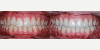 18-24 year old woman treated with Lingual Braces - This adult female patient came to us with mild crowding, a moderate overbite, and moderate overjet. Her lower midline was 2mm to the right of center. Dr. Benson began her treatment with the Carriere Motion Appliance for the first 3 months of her treatment (she had excellent rubber band wear!).